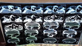 شاب يستعيد نظره بعد اجراء عملية طارئة في مدينة الصدر الطبية