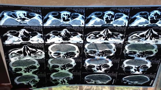 شاب يستعيد نظره بعد اجراء عملية طارئة في مدينة الصدر الطبية