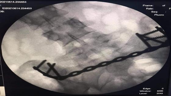 عملية جراحية معقدة لتثبيت كسور الحوض لفتاة في السابعة عشر في مدينة الصدر الطبية في النجف