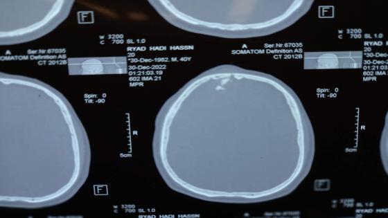 دائرة الصحة: انقاذ مريض باستخراج طلق ناري من الرأس في مدينة الصدر الطبية